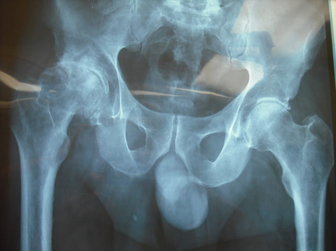 Aρθρίτιδα ισχίου α4