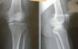 Αρθρίτιδα γόνατος σε άνδρα 49 ετών1