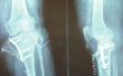 Διενέργεια οστεοτομίας γόνατος 2