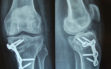Οστεοτομία κνήμης σε γυναίκα 42 ετων με αρθρίτιδα γόνατος